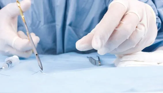 Stitching the wound
