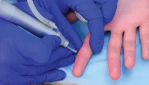 Wart removal, skin tag removal, keloid injection