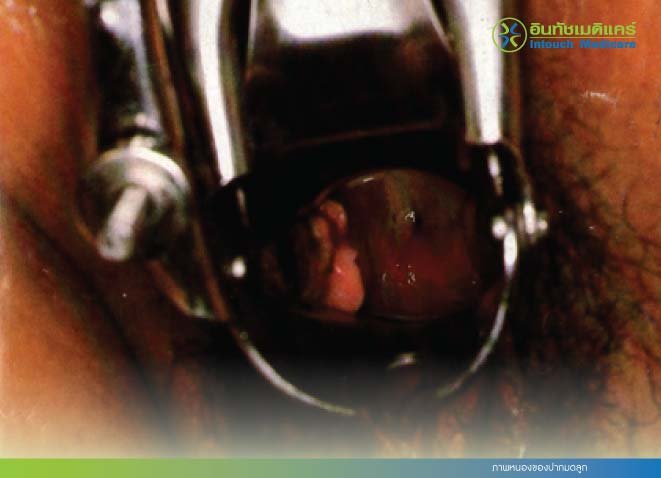ภาพหนองของปากมดลูก ภาพหนองของปากมดลูก