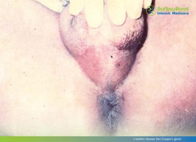ภาพแสดง abscess ของ Cowper’s gland ภาพแสดง abscess ของ Cowper’s gland